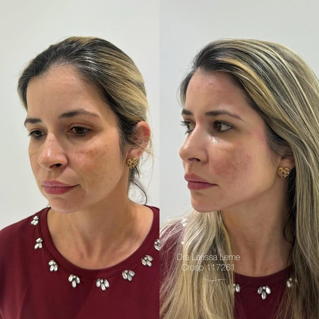 Você não esta cansada,Só precisa de uma dose de rejuvenescimento ️ #harmonizacaofacial (1) (1)
