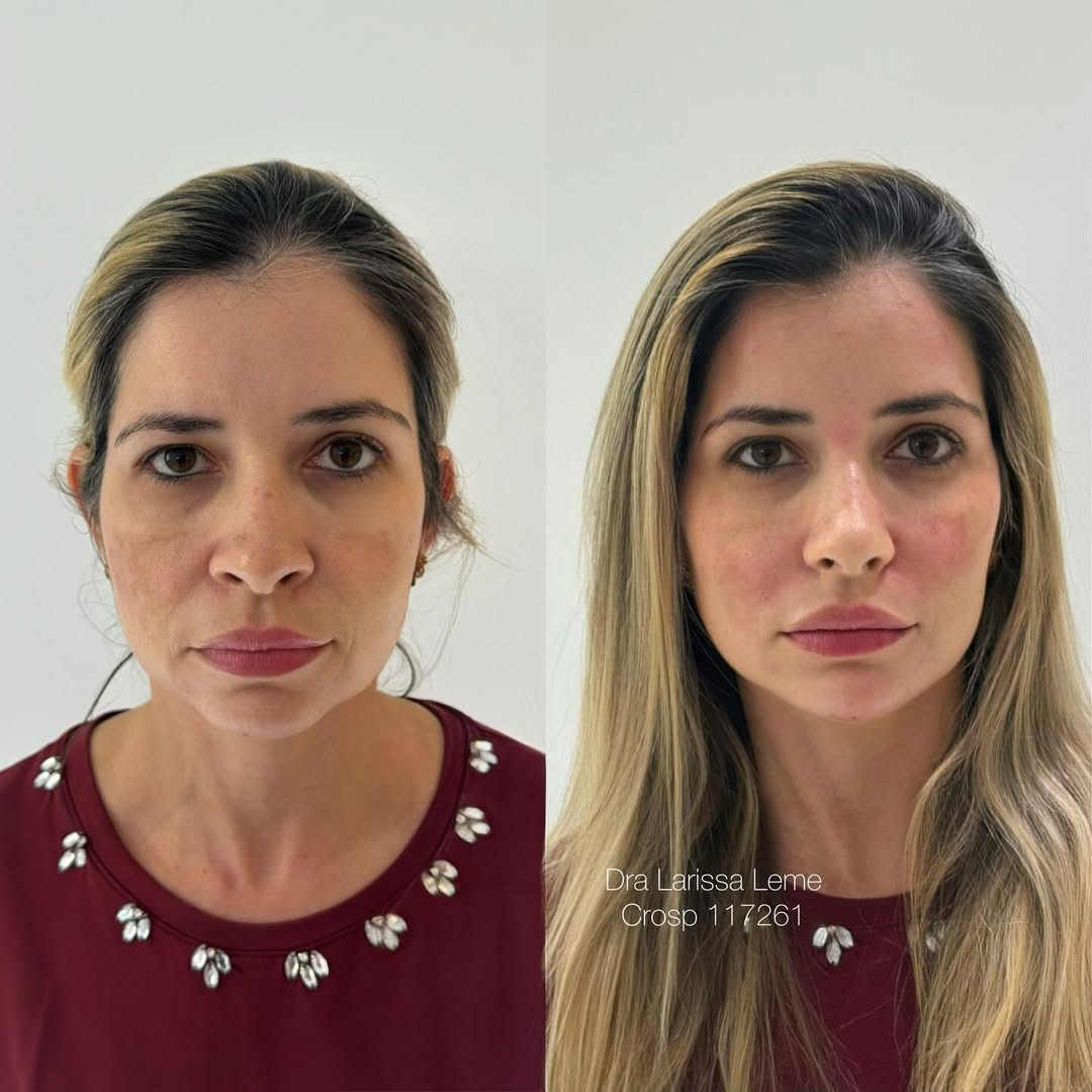 Você não esta cansada,Só precisa de uma dose de rejuvenescimento ️ #harmonizacaofacial (1)
