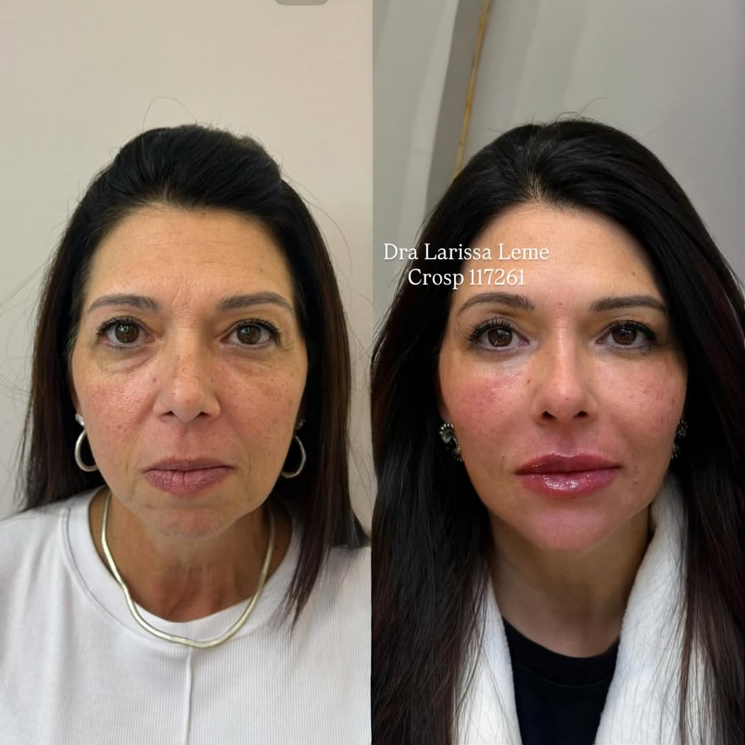 Rejuvenescimento completo com ácido hialurônico e Plla.Não é sobre aprender uma técnica de preen (2)