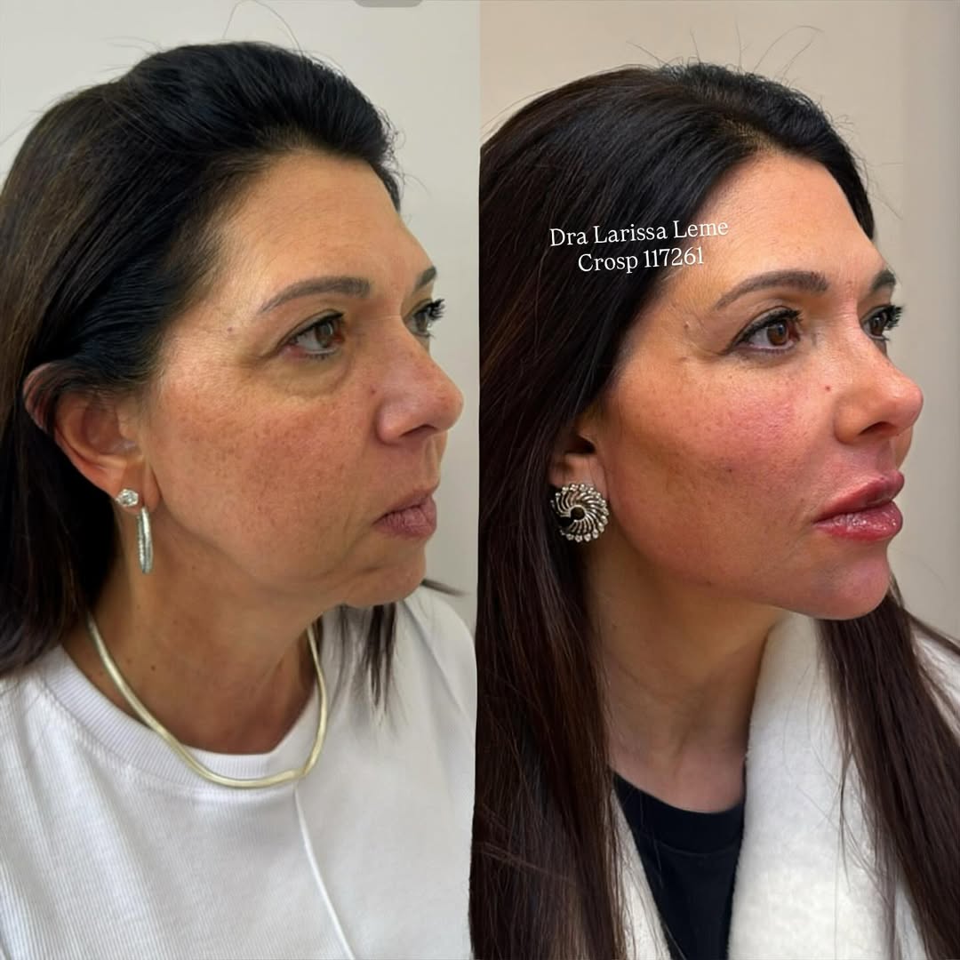 Rejuvenescimento completo com ácido hialurônico e Plla.Não é sobre aprender uma técnica de preen